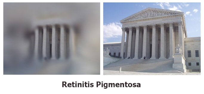 Retinitis-Pigmentosa