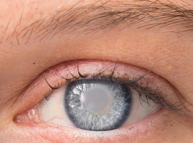 cataract-eye-right