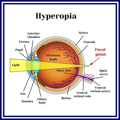 hyperopia-4