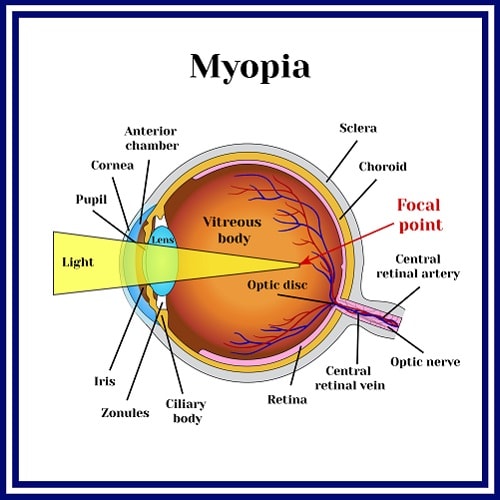 myopia-image