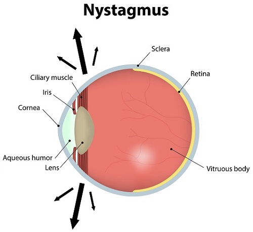 nystagmus-1