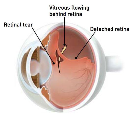 retinal-detachment